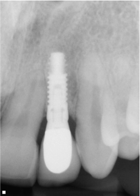 dental_implant