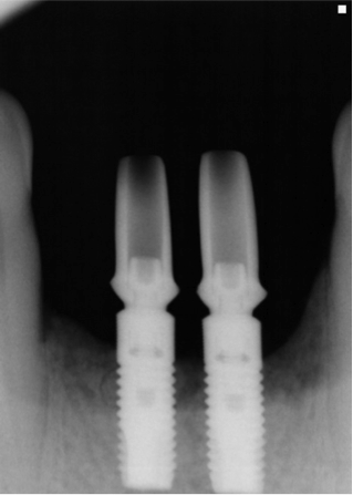 dental_implant